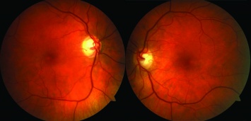 Генетики нашли биомаркеры редкого заболевания глаз
