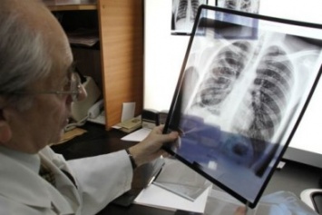 В Днепре появились первые результаты обследования на туберкулез