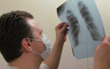Медики Днепра борются с туберкулезом