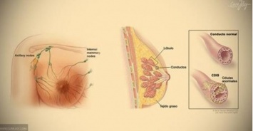 5 очевидных признака рака груди: не стоит игнорировать!