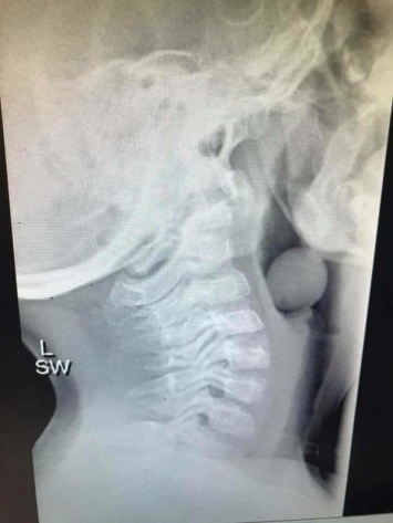 Этот рентгеновский снимок 5-летнего ребенка показывает, почему детям нельзя есть без присмотра