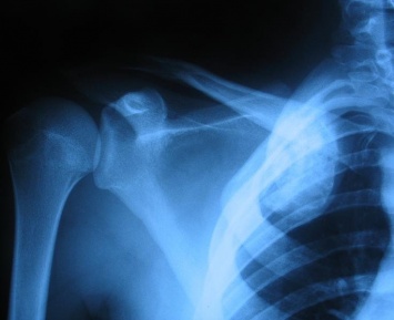 Ученые рассказали о риске смерти пациентов с метастазами в костях