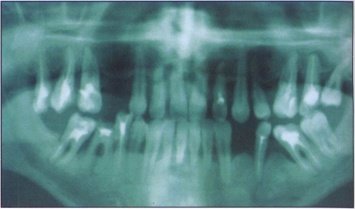 Ортодонты: 13% случаев самостоятельного лечения зуба приводят к его потере