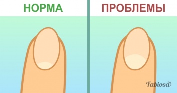 Вот о каких заболеваниях расскажут лунки на ногтях