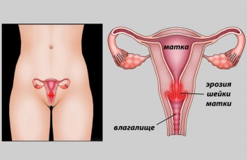 Каждая вторая женщина страдает от эрозии шейки матки! Пора разорвать этот заколдованный круг
