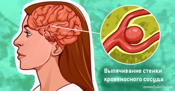 Вот буквально все, что нужно знать об аневризме головного мозга