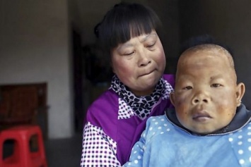 30-летний китаец выглядит, как 2-летний ребенок из-за необычной болезни