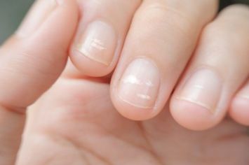 Полоски на ногтях: откуда они и что это значит