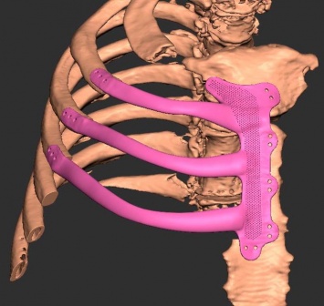 Британские врачи напечатали имплантат грудной клетки на 3D-принтере