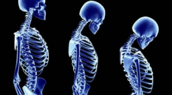 Ученые заявили, что остеокласты вызывают хрупкость костей у людей с ВИЧ-инфекцией