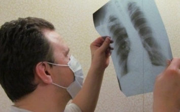 На Днепропетровщине готовятся к месячнику по борьбе с туберкулезом