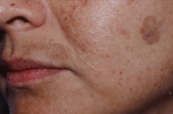 Как вывести коричневые пятна на лице: всего лишь два простых компонента