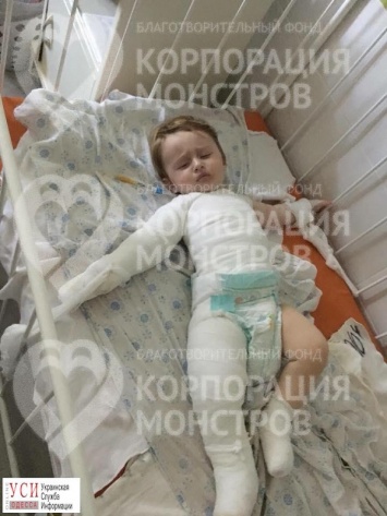В Одессе собирают помощь для малыша с ожогами 40% тела