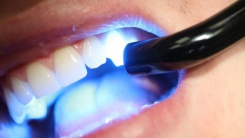 Китайские ученые нашли способ безопасно отбеливать зубы синим светом