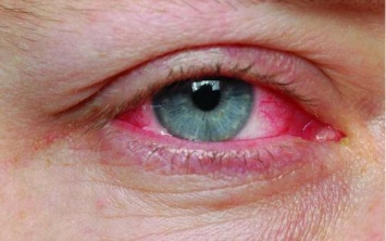Ученые: Причиной глаукомы может быть аутоиммунное расстройство