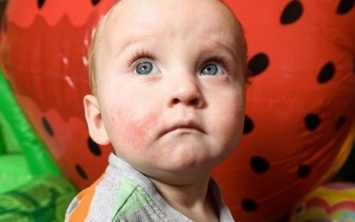 Британский мальчик родился с 50 видами аллергии: уникальная жизнь ребенка