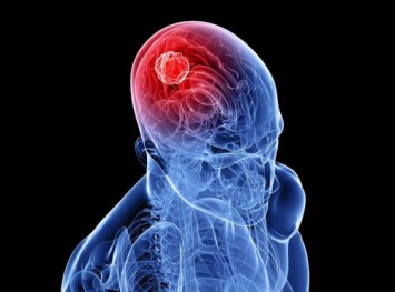Близится победа над раком: Ученые замедлили рост опухоли мозга