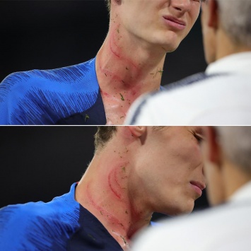 Павар рассказал о шраме, который он получил в матче с Германией (ФОТО)