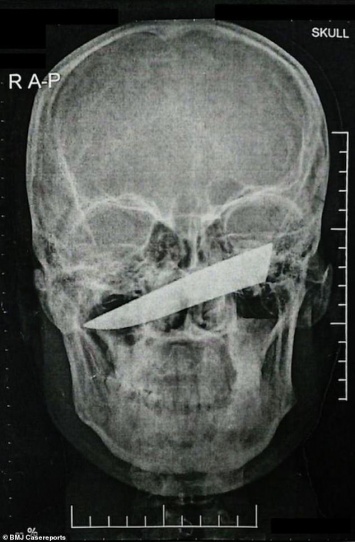 Остался жив: африканец проходил с лезвием ножа в глазу 4 дня