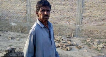 Страшные опухоли по всему телу медленно убивают жителя Пакистана