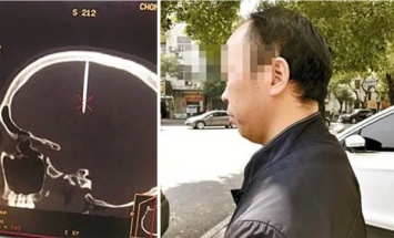 Житель Китая неделю ходил с пробитой гвоздем головой (фото)