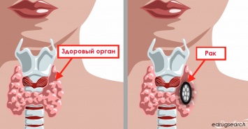 30 симптомов хронического расстройства щитовидной железы