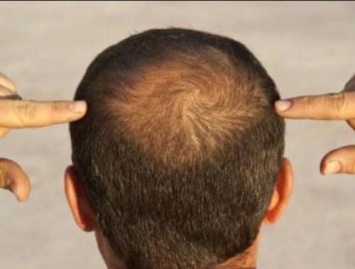 Найден новый генетический виновник раннего прогрессирующего выпадения волос