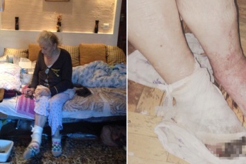 В РФ умерла пенсионерка, которой ампутировали здоровую ногу