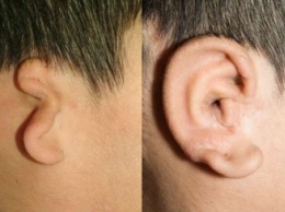 Трехмерная печать помогла медикам создать человеческое ухо