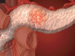 Ученые разделили рак поджелудочной железы на 4 разных заболевания