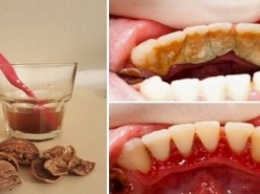 Как избавиться от зубного камня при помощи 1 простого средства