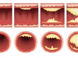 10 продуктов, которые прочистят ваши артерии и защитят от сердечного приступа