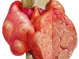 Узловой зоб щитовидной железы - симптомы и лечение