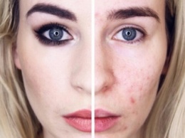 Блогер показала, что происходит с кожей при лечении акне "Роаккутаном"