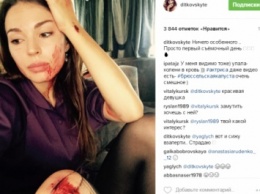 Агния Дитковските опубликовала фото с травмами и ссадинами