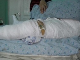В Черноморске после проникновения в чужую собственность, парень оказался в больнице с переломом обеих ног