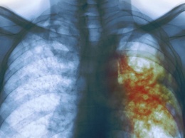 Ученые объяснили особую опасность «русского» туберкулеза