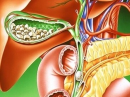 Желчнокаменная болезнь может увеличить риск сердечных заболеваний