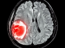 Новая компьютерная программа лучше врачей способна выявлять рак мозга