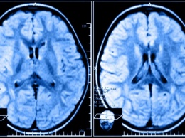 Ученые: Марихуана разрушающе действует на мозг и приводит к слабоумию