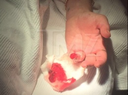 Известной актрисе Линдси Лохан оторвало палец! (ФОТО)