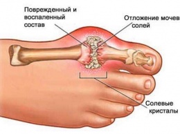 Как быстро удалить мочекислую кристаллизацию для предотвращения подагры и боли в суставах