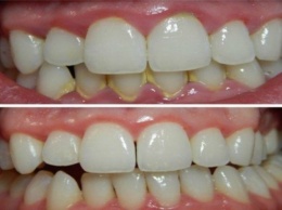 Как удалить зубной налет за 5 минут естественным способом без визита к стоматологу!