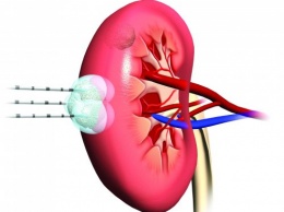 Ученые нашли лекарство, которое снижает вероятность рецидива рака почки