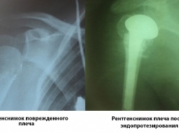 Травматологи Запорожской облбольницы спасли пациентку с раздробленным плечом (фото)