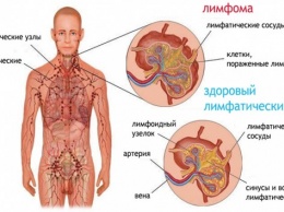 Открыт механизм возникновения лимфомы Ходжкина