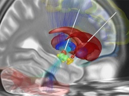 Названы опасные последствия глубокой стимуляции мозга