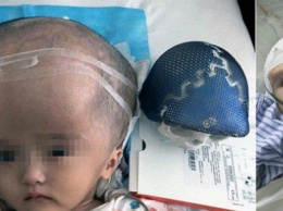 Девочке пересадили распечатанный на 3D-принтере череп (ФОТО)