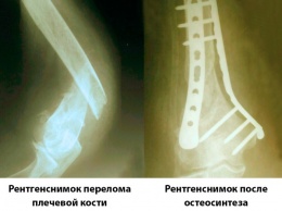 Запорожские травматологи применяют современные методики лечения переломов: остеосинтез вместо неудобного гипса