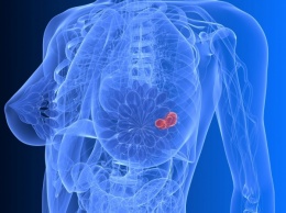 Женщины на ранней стадии рака груди борются с болью в суставах с помощью антидепрессанта